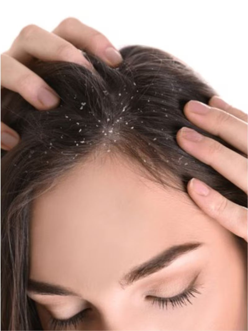 Dandruff / Itchy Scalp